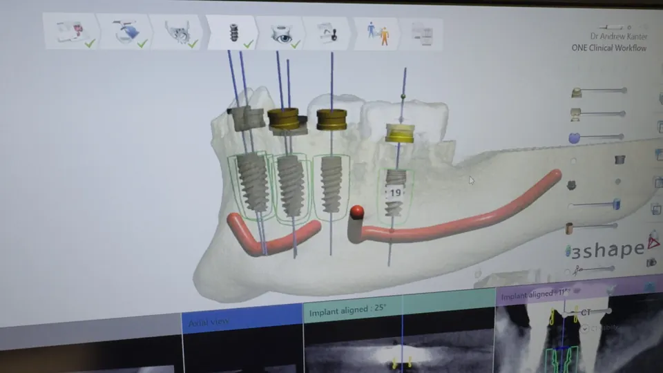 A digital implant plan shown on a screen