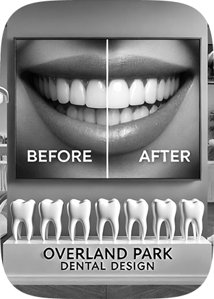 Before and After Dental Veneers