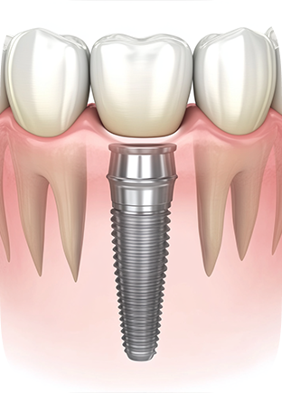 7 Life-Changing Benefits of Dental Implants: What Patients Need to Know