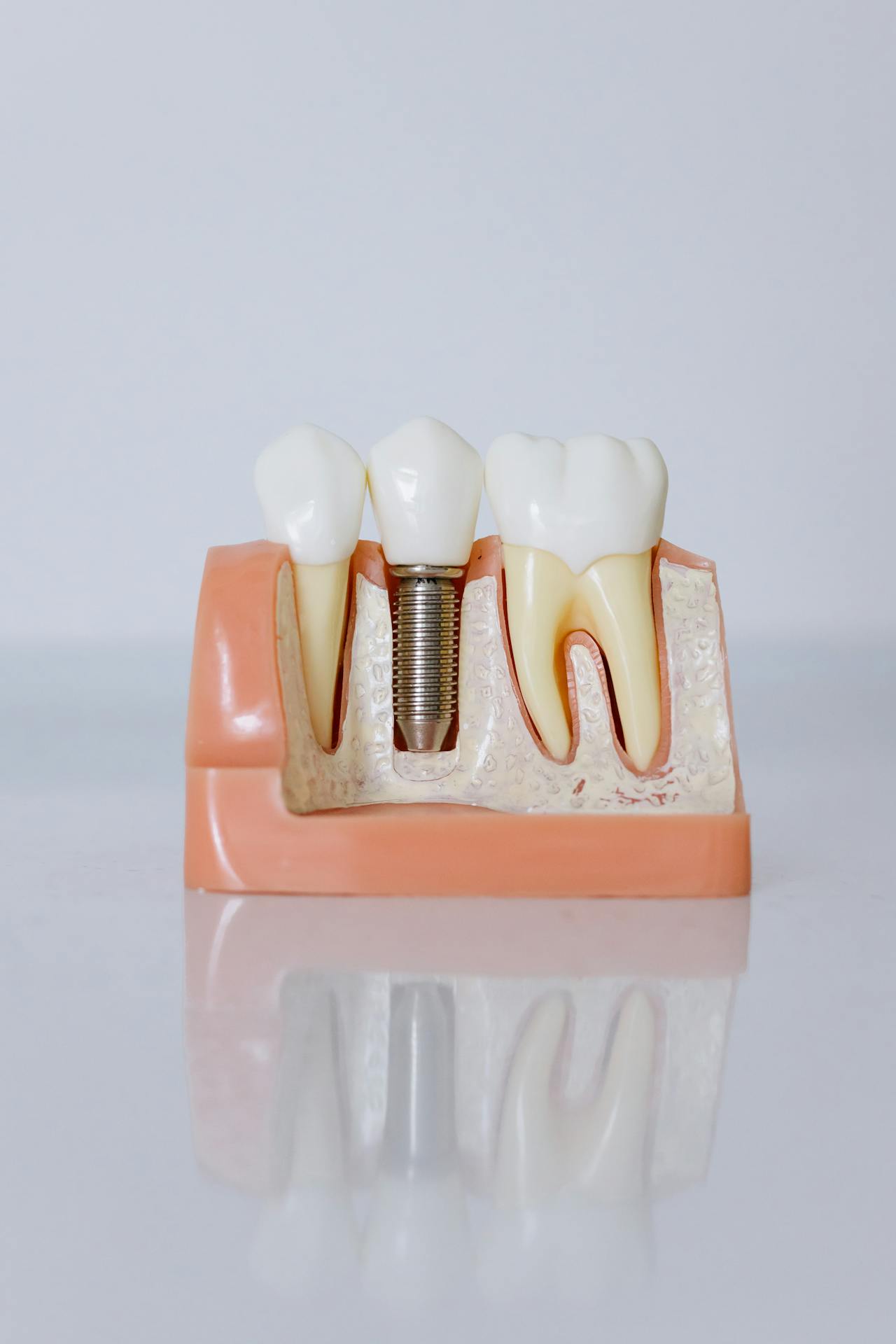 Fixed Dentures in Leawood KS